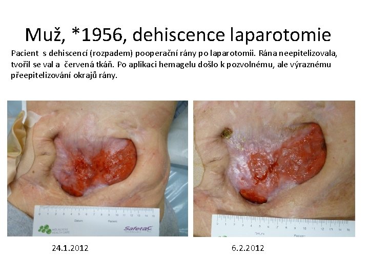 Muž, *1956, dehiscence laparotomie Pacient s dehiscencí (rozpadem) pooperační rány po laparotomii. Rána neepitelizovala,