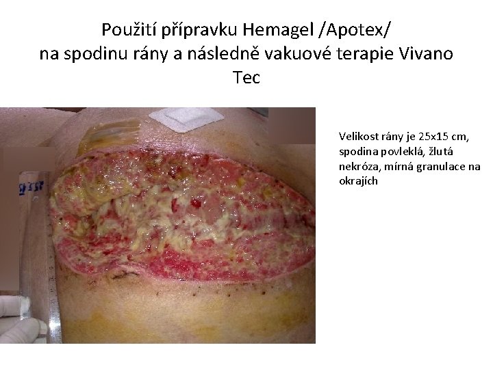 Použití přípravku Hemagel /Apotex/ na spodinu rány a následně vakuové terapie Vivano Tec Velikost