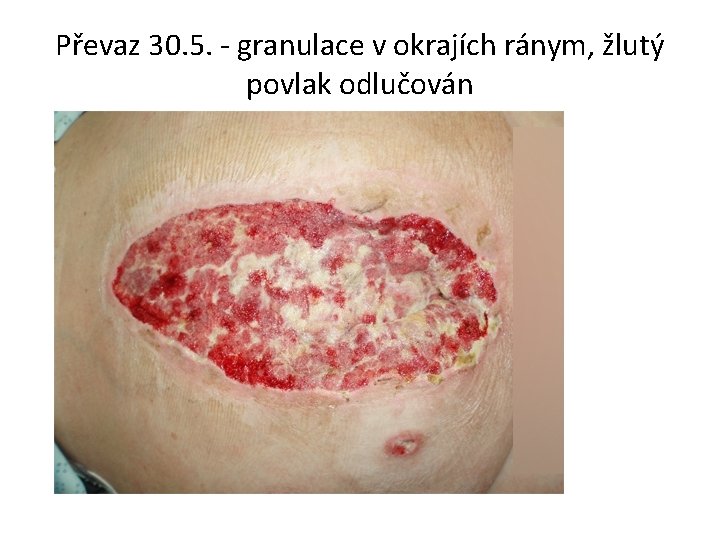 Převaz 30. 5. - granulace v okrajích ránym, žlutý povlak odlučován 