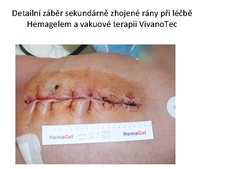 Detailní záběr sekundárně zhojené rány při léčbě Hemagelem a vakuové terapii Vivano. Tec 