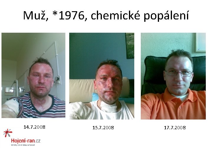 Muž, *1976, chemické popálení 14. 7. 2008 15. 7. 2008 17. 7. 2008 