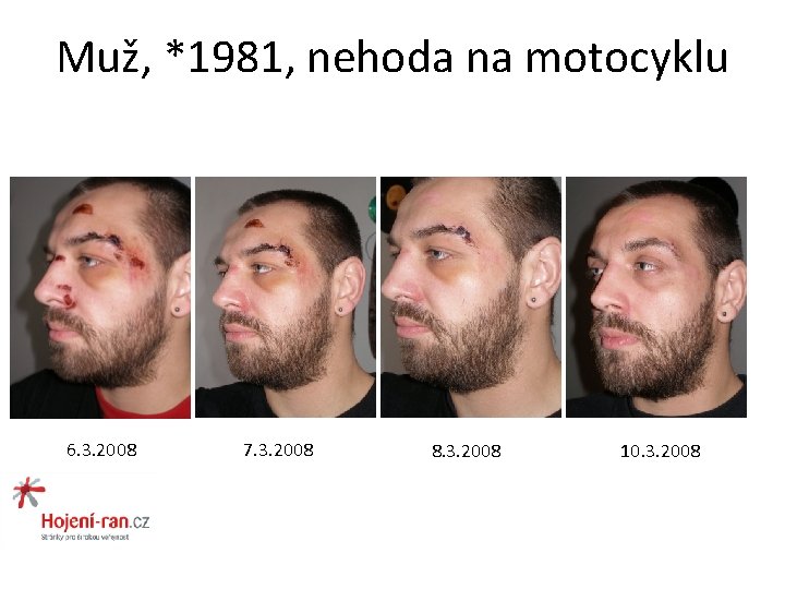 Muž, *1981, nehoda na motocyklu 6. 3. 2008 7. 3. 2008 8. 3. 2008