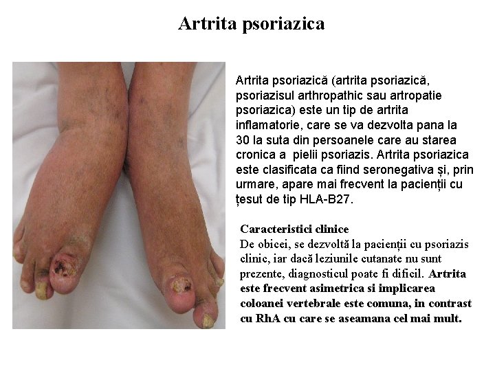 Artrita psoriazica Artrita psoriazică (artrita psoriazică, psoriazisul arthropathic sau artropatie psoriazica) este un tip