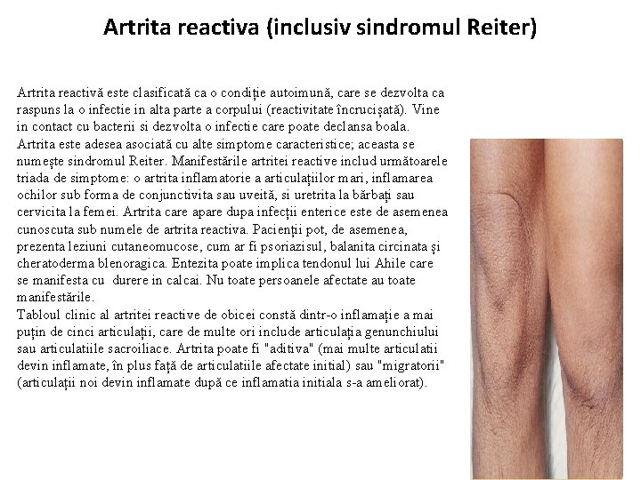 Artrita reactiva (inclusiv sindromul Reiter) Artrita reactivă este clasificată ca o condiție autoimună, care