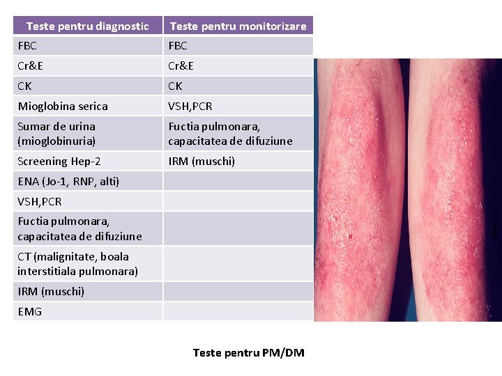 Teste pentru diagnostic Teste pentru monitorizare FBC Cr&E CK CK Mioglobina serica VSH, PCR