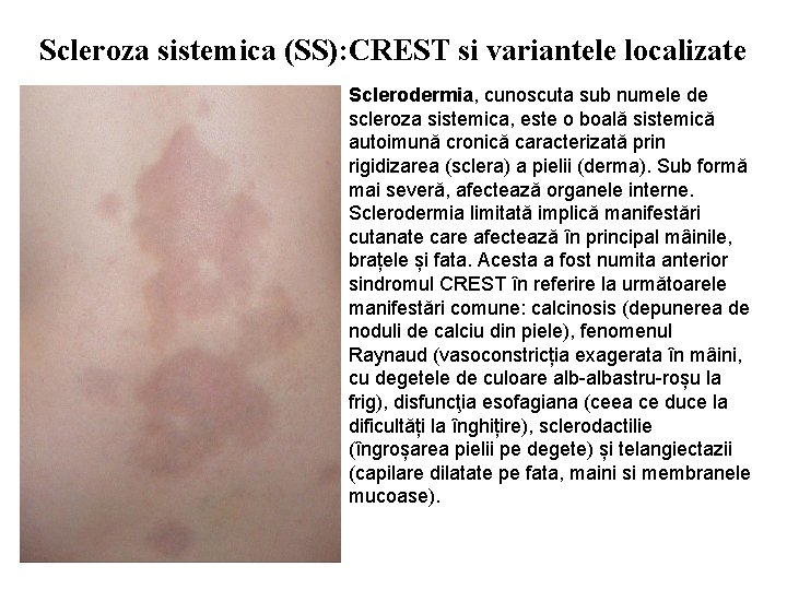 Scleroza sistemica (SS): CREST si variantele localizate Sclerodermia, cunoscuta sub numele de scleroza sistemica,