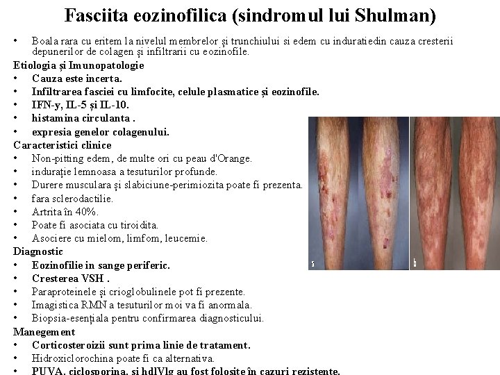 Fasciita eozinofilica (sindromul lui Shulman) • Boala rara cu eritem la nivelul membrelor și