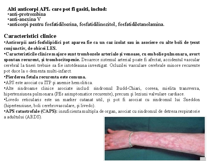 Alti anticorpi APL care pot fi gasiti, includ: • anti-protrombina • anti-anexina V •