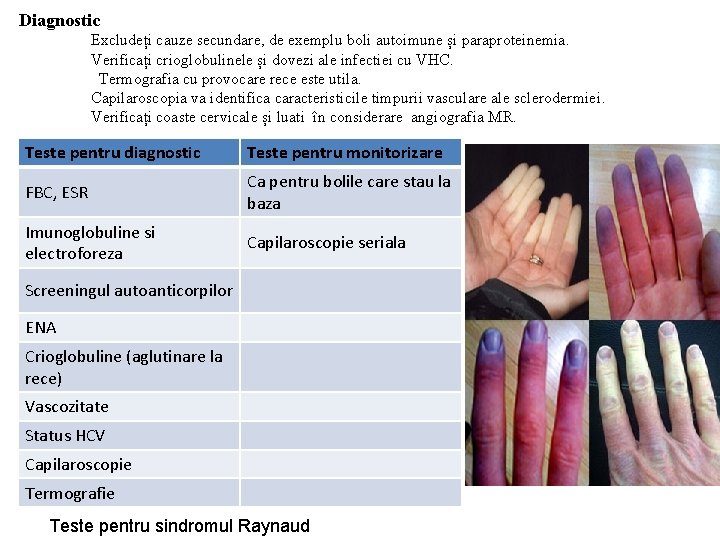 Diagnostic Excludeți cauze secundare, de exemplu boli autoimune și paraproteinemia. Verificați crioglobulinele și dovezi