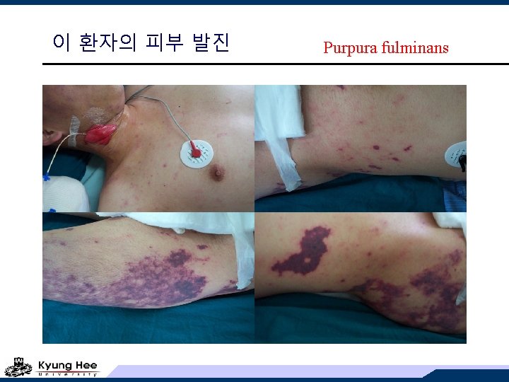 이 환자의 피부 발진 Purpura fulminans 