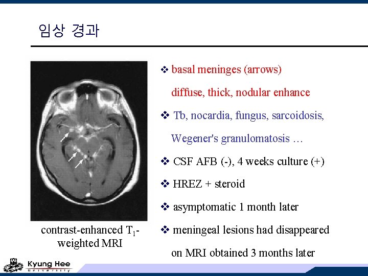 임상 경과 v basal meninges (arrows) diffuse, thick, nodular enhance v Tb, nocardia, fungus,