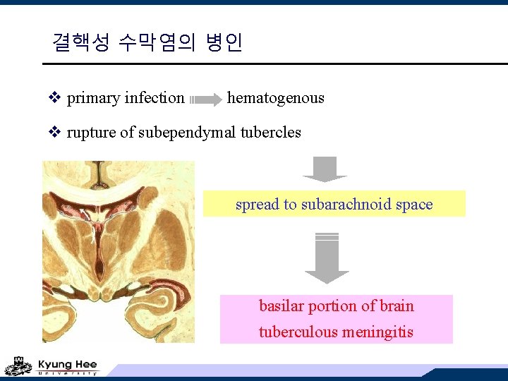 결핵성 수막염의 병인 v primary infection hematogenous v rupture of subependymal tubercles spread to
