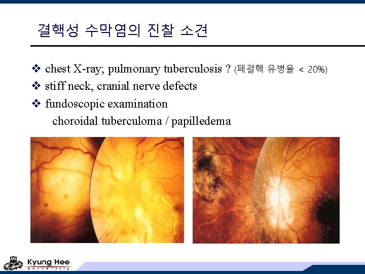 결핵성 수막염의 진찰 소견 v chest X-ray; pulmonary tuberculosis ? (폐결핵 유병율 &lt; 20%)