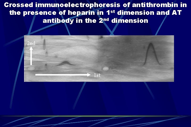 Crossed immunoelectrophoresis of antithrombin in the presence of heparin in 1 st dimension and