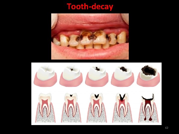 Tooth-decay 62 