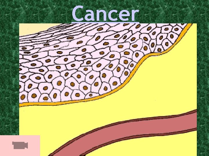 Cancer 