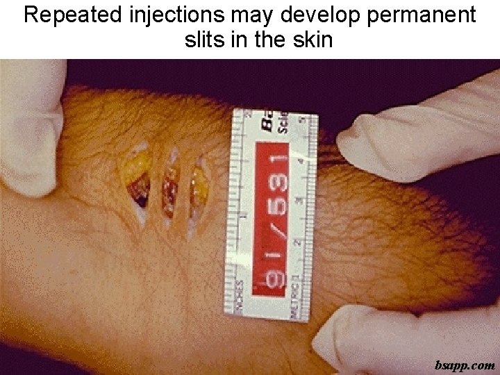Repeated injections may develop permanent slits in the skin bsapp. com 