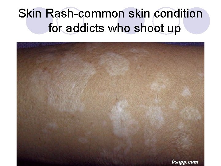 Skin Rash-common skin condition for addicts who shoot up bsapp. com 