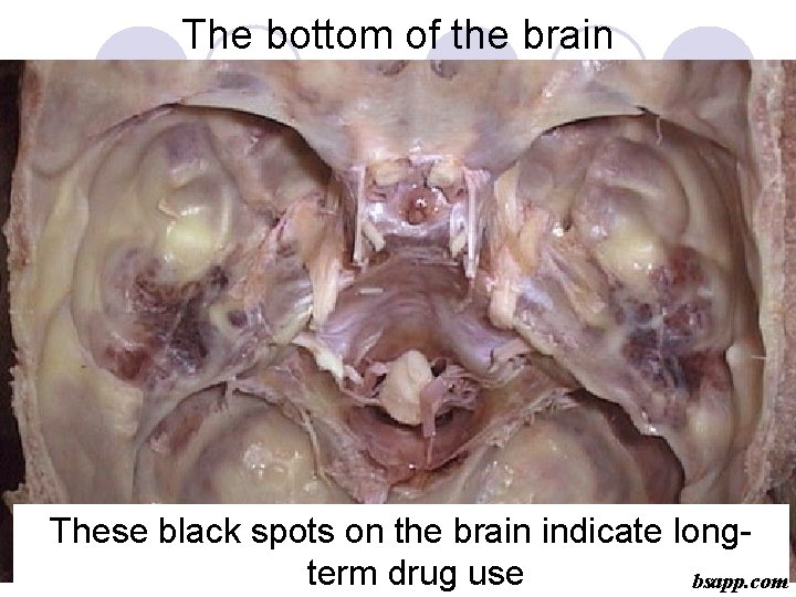 The bottom of the brain These black spots on the brain indicate longterm drug