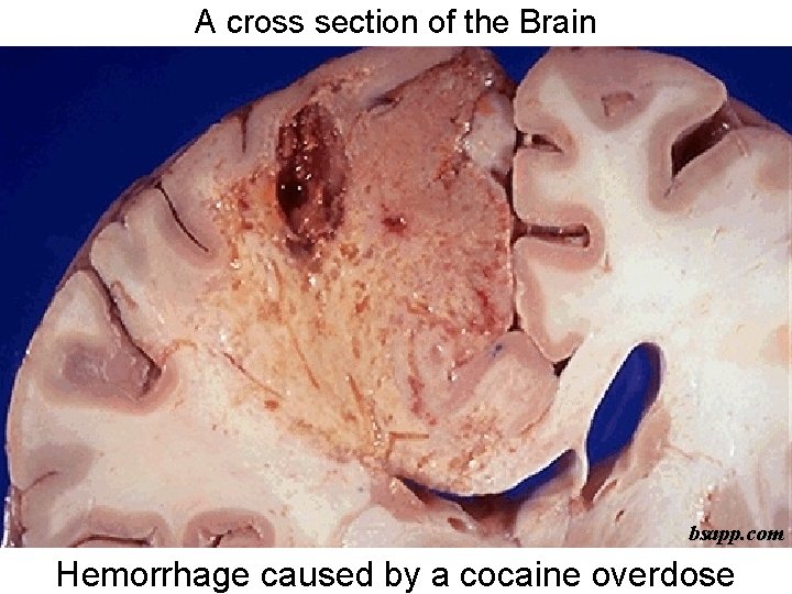 A cross section of the Brain bsapp. com Hemorrhage caused by a cocaine overdose