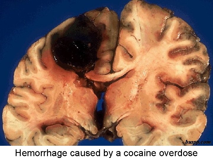 bsapp. com Hemorrhage caused by a cocaine overdose 