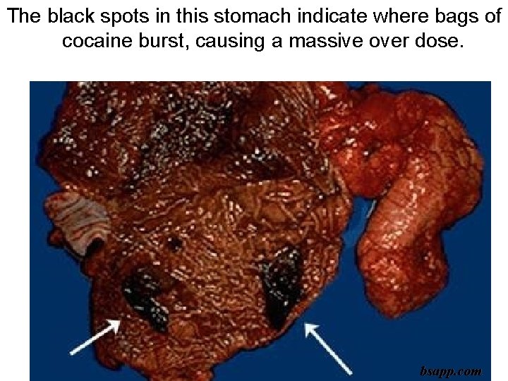The black spots in this stomach indicate where bags of cocaine burst, causing a