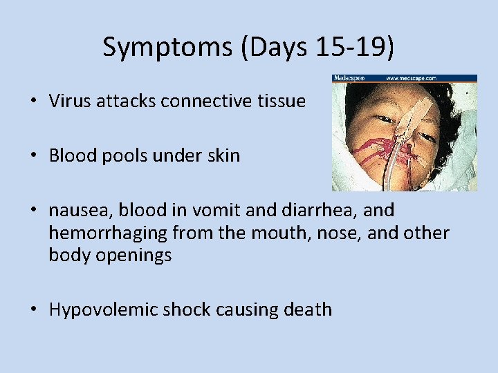 Symptoms (Days 15 -19) • Virus attacks connective tissue • Blood pools under skin