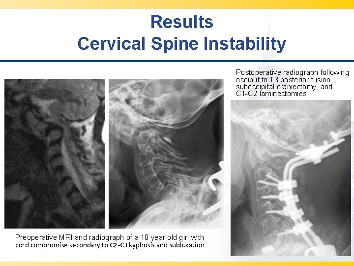 Results Cervical Spine Instability Postoperative radiograph following occiput to T 3 posterior fusion, suboccipital