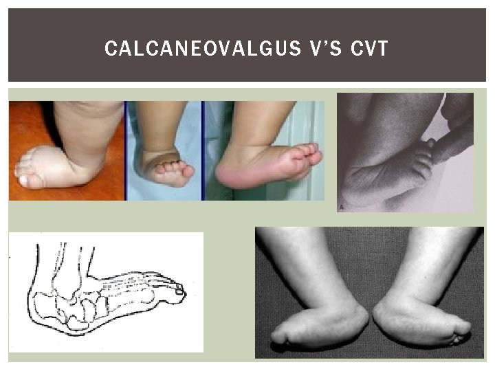 CALCANEOVALGUS V’S CVT 