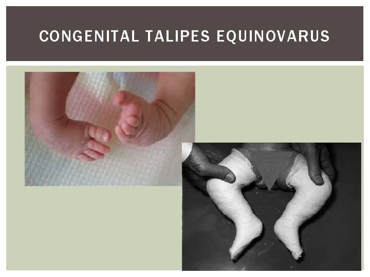 CONGENITAL TALIPES EQUINOVARUS 