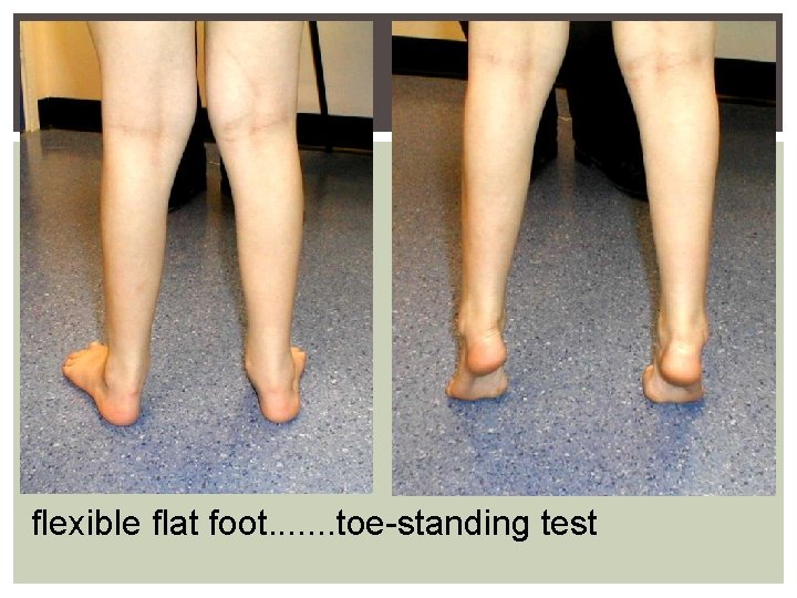 flexible flat foot. . . . toe-standing test 