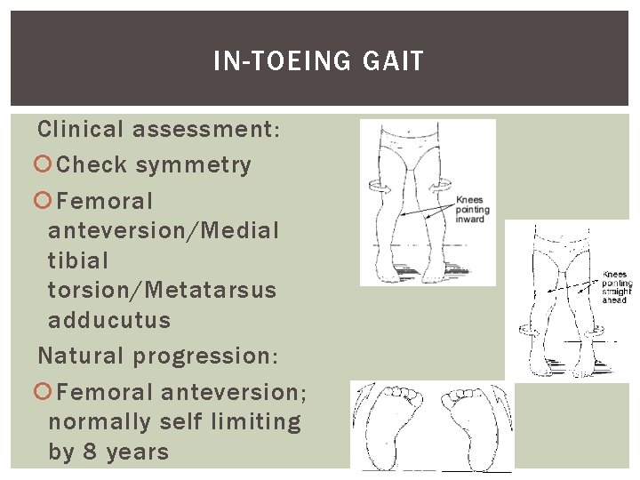 IN-TOEING GAIT Clinical assessment: Check symmetry Femoral anteversion/Medial tibial torsion/Metatarsus adducutus Natural progression: Femoral