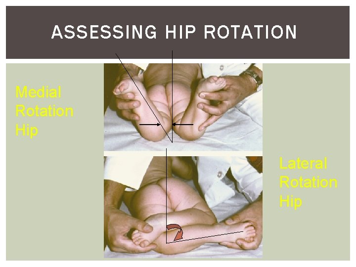 ASSESSING HIP ROTATION Medial Rotation Hip Lateral Rotation Hip 
