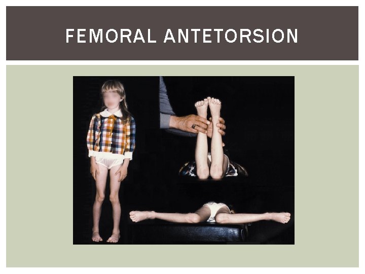 FEMORAL ANTETORSION 