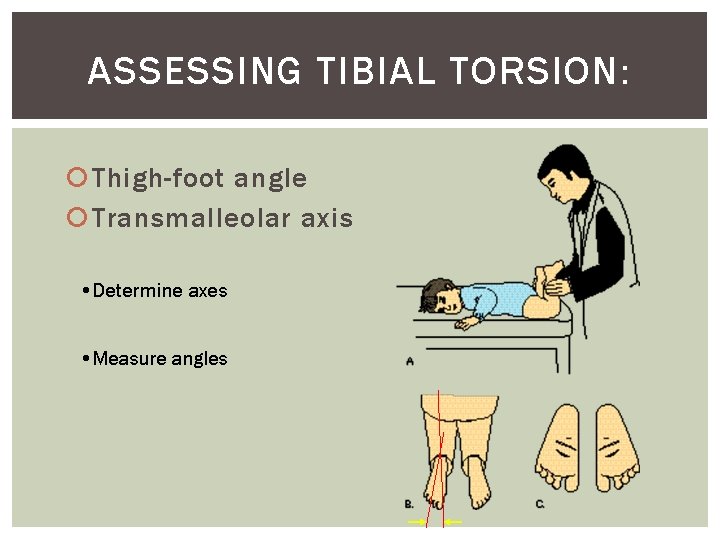 ASSESSING TIBIAL TORSION: Thigh-foot angle Transmalleolar axis • Determine axes • Measure angles 