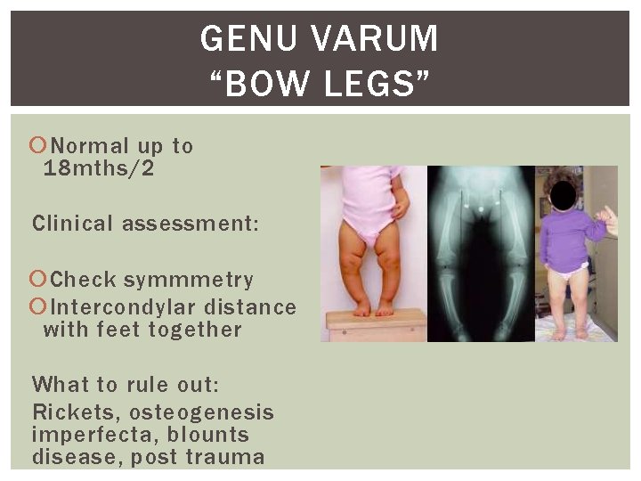 GENU VARUM “BOW LEGS” Normal up to 18 mths/2 Clinical assessment: Check symmmetry Intercondylar