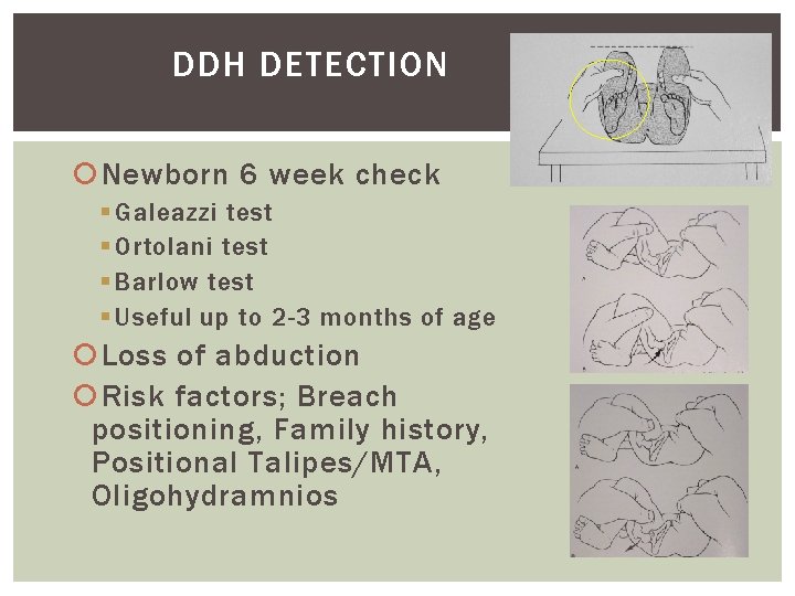 DDH DETECTION Newborn 6 week check § Galeazzi test § Ortolani test § Barlow