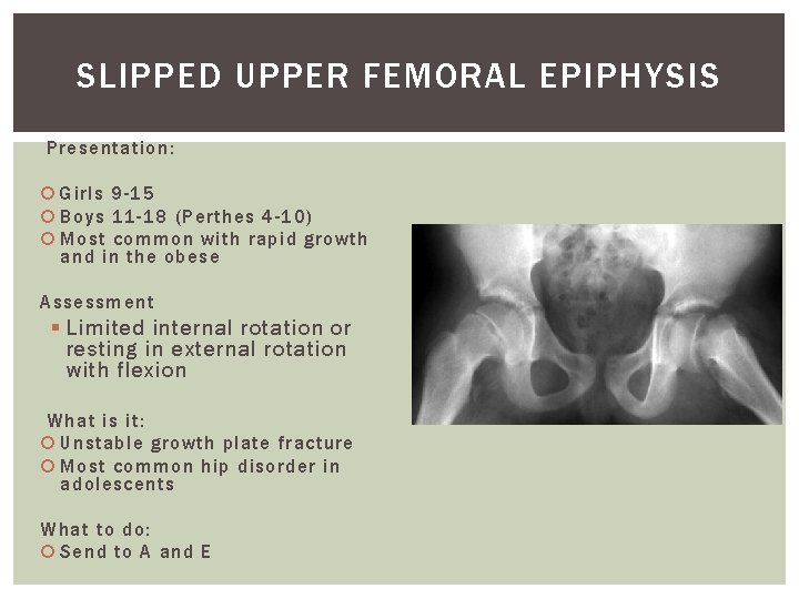 SLIPPED UPPER FEMORAL EPIPHYSIS Presentation: Girls 9 -15 Boys 11 -18 (Perthes 4 -10)