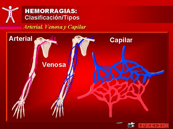 HEMORRAGIAS: Clasificación/Tipos Arterial, Venosa y Capilar Arterial Capilar Venosa 