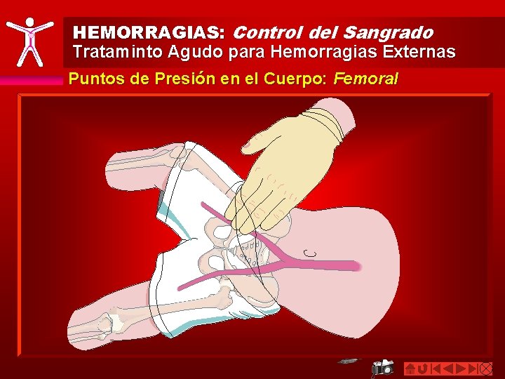 HEMORRAGIAS: Control del Sangrado Trataminto Agudo para Hemorragias Externas Puntos de Presión en el