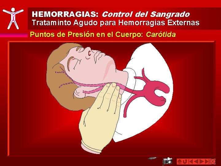 HEMORRAGIAS: Control del Sangrado Trataminto Agudo para Hemorragias Externas Puntos de Presión en el