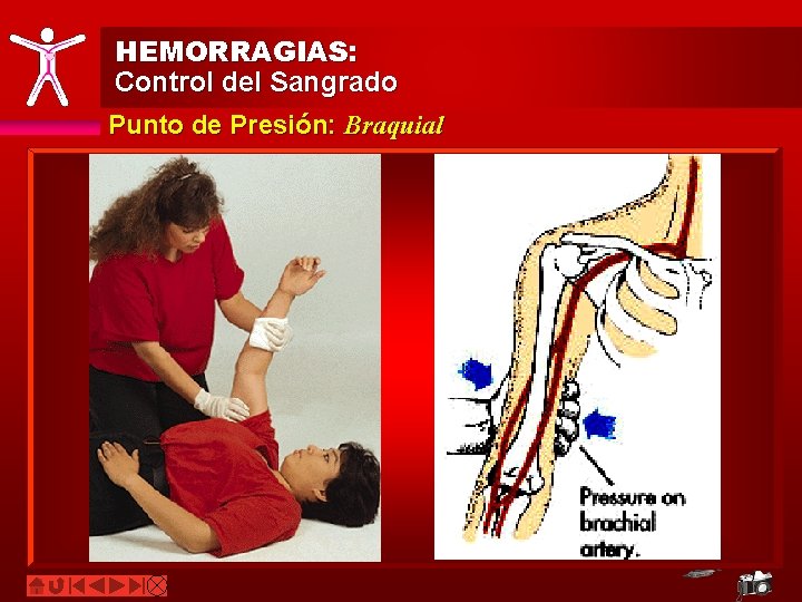 HEMORRAGIAS: Control del Sangrado Punto de Presión: Braquial 