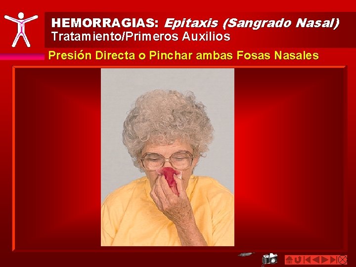 HEMORRAGIAS: Epitaxis (Sangrado Nasal) Tratamiento/Primeros Auxilios Presión Directa o Pinchar ambas Fosas Nasales 