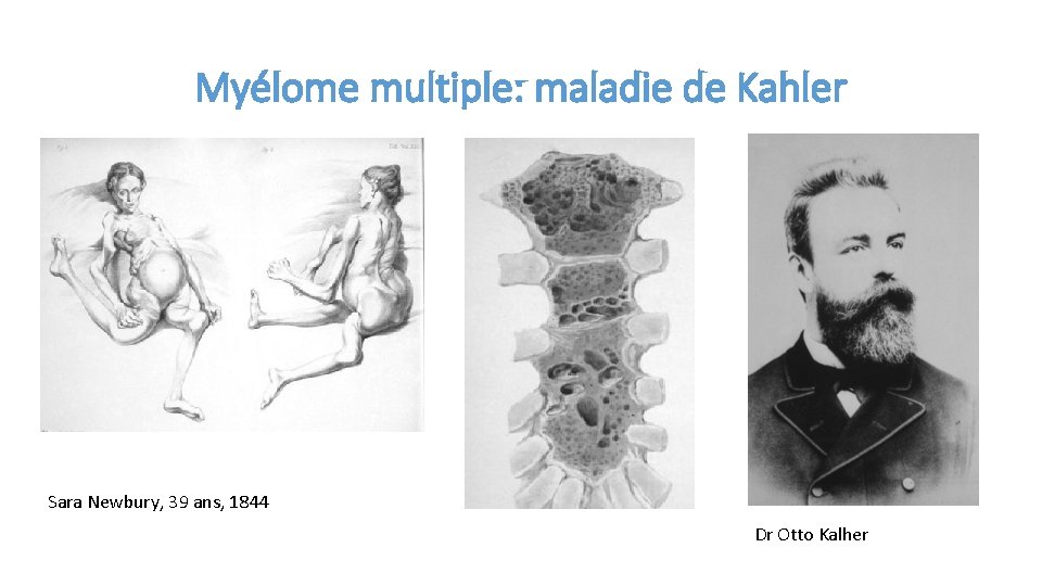 Myélome multiple: maladie de Kahler Sara Newbury, 39 ans, 1844 Dr Otto Kalher 