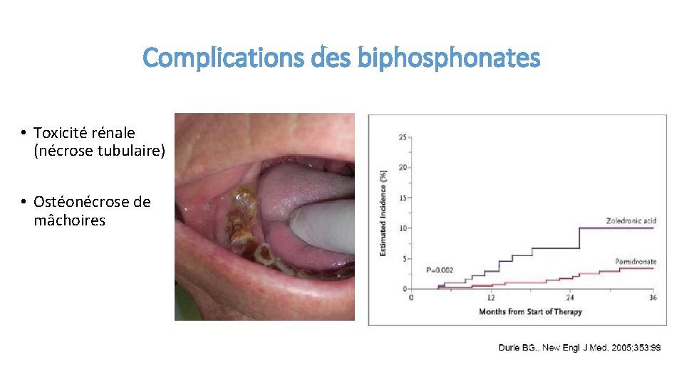 Complications des biphosphonates • Toxicité rénale (nécrose tubulaire) • Ostéonécrose de mâchoires 