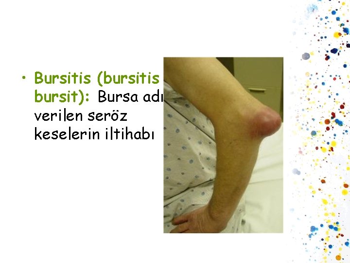 • Bursitis (bursitis / bursit): Bursa adı verilen seröz keselerin iltihabı 