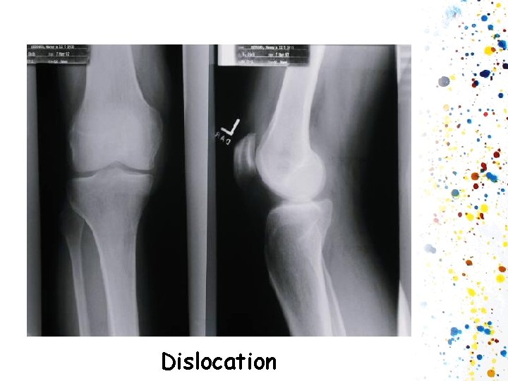 Dislocation 