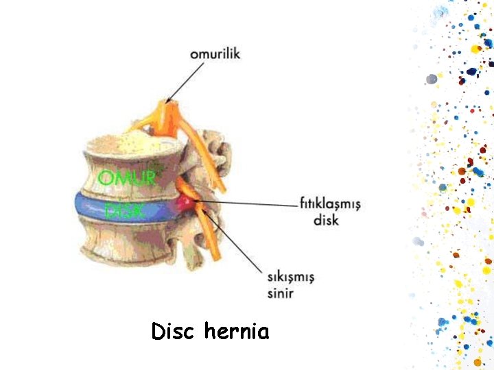 Disc hernia 