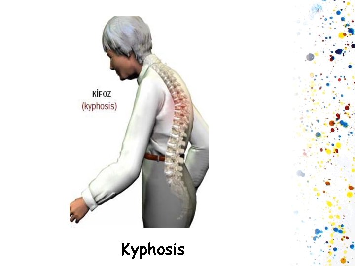 Kyphosis 