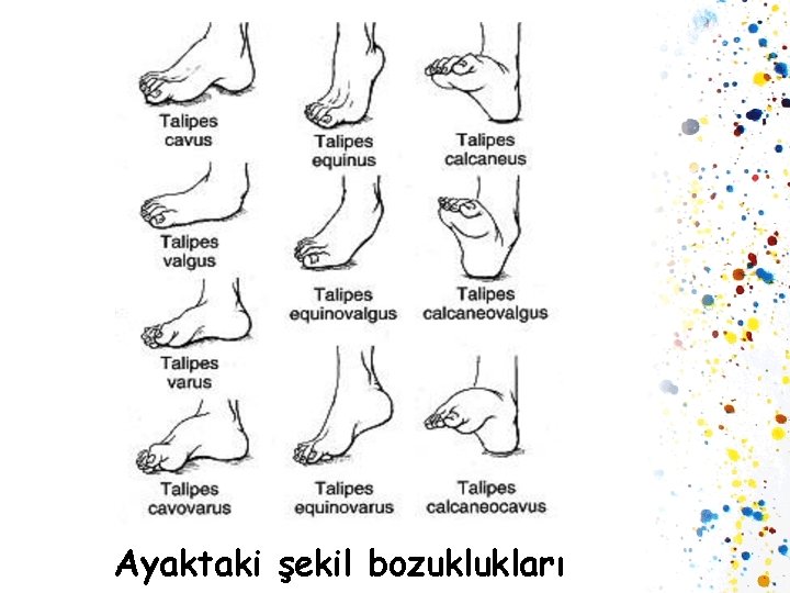 Ayaktaki şekil bozuklukları 